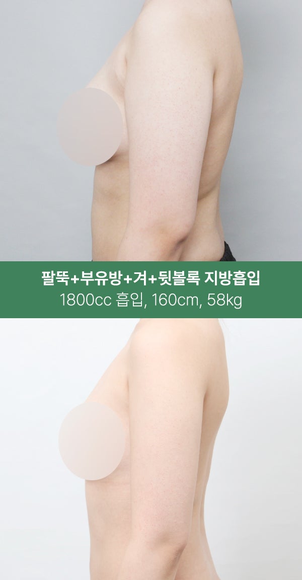 팔뚝·부유방·겨드랑이까지 1800cc 지방흡입 사진 3