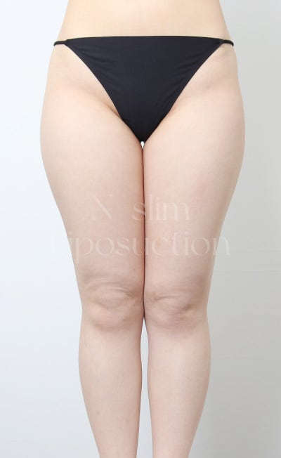 실제 사례로 보는 부위별 지방흡입 (+전후사진) 사진 21