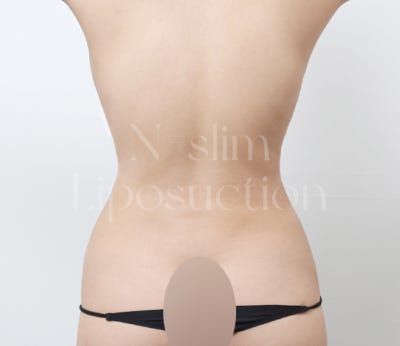 실제 사례로 보는 부위별 지방흡입 (+전후사진) 사진 18