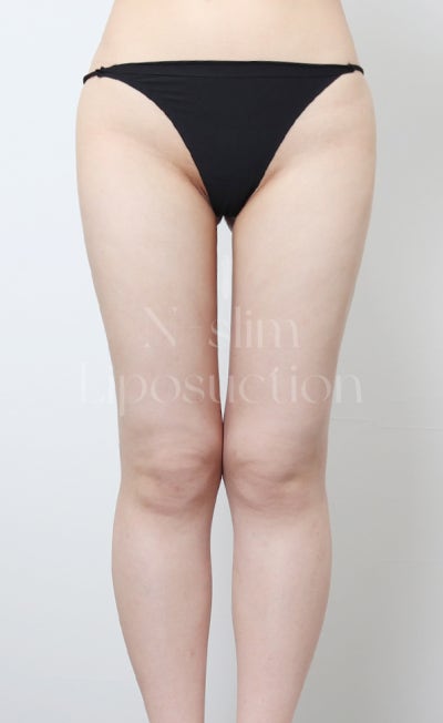 실제 사례로 보는 부위별 지방흡입 (+전후사진) 사진 22