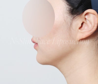 이중턱 지방흡입 50cc 실제사례, 전후 비교 사진 4