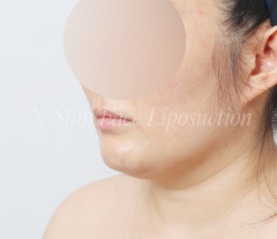 이중턱 지방흡입 50cc 실제사례, 전후 비교 사진 7