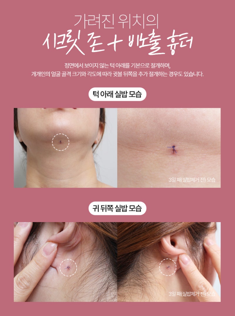 이중턱 지방흡입 50cc 실제사례, 전후 비교 사진 12