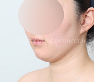 이중턱 지방흡입 50cc 실제사례, 전후 비교