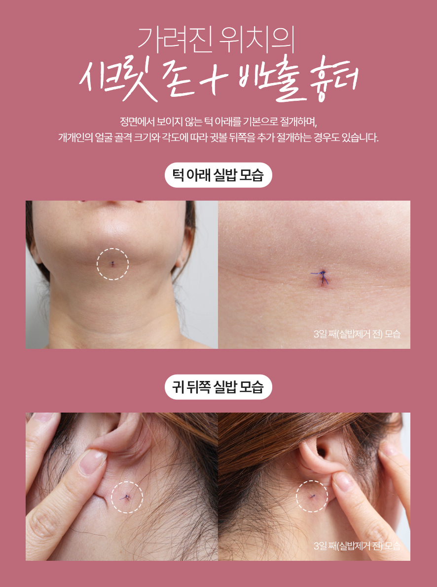 이중턱 지방흡입 50cc 실제사례, 전후사진 비교 사진 12