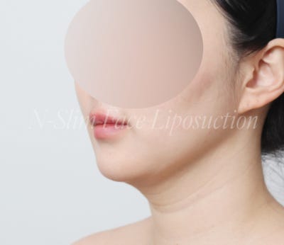 이중턱 지방흡입 50cc 실제사례, 전후사진 비교 사진 2