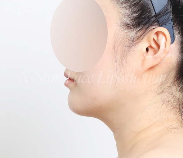 이중턱 지방흡입 50cc 실제사례, 전후사진 비교 사진 10