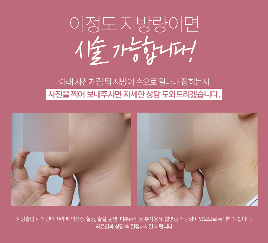 이중턱 지방흡입 50cc 실제사례, 전후사진 비교 사진 6