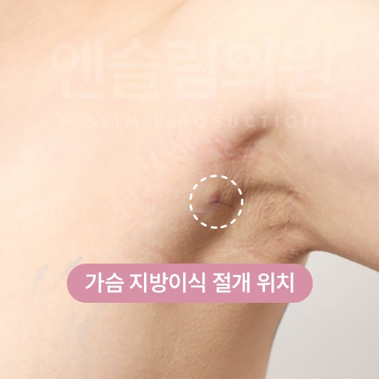 자연스러운 가슴 볼륨을 원한다면? (+실제전후) 사진 7