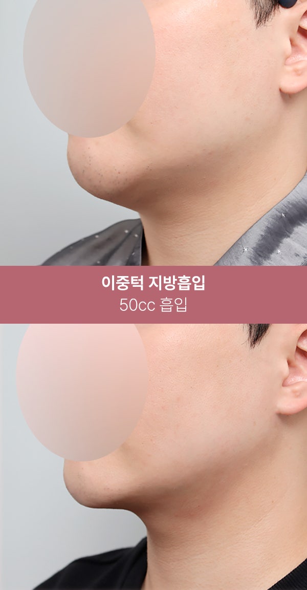이중턱 지방흡입으로 또렷한 턱선 (+실제사례) 사진 6