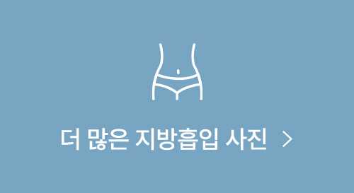 이중턱 지방흡입으로 또렷한 턱선 (+실제사례) 사진 12