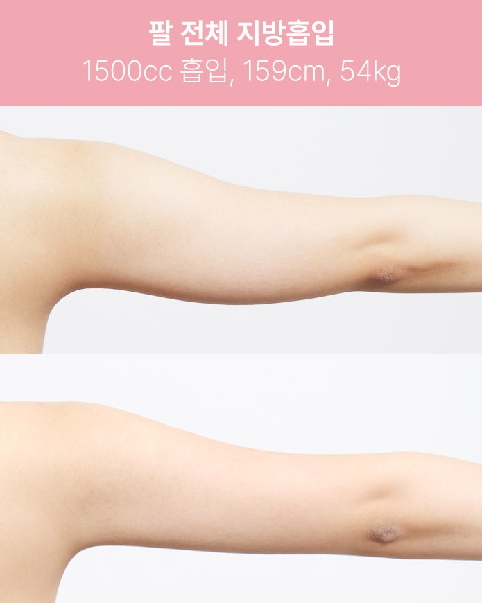 팔 전체 지방흡입 1500cc 실제 사례 사진 7