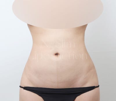 2,400cc 복부 지방흡입, 전후사진 비교 사진 2