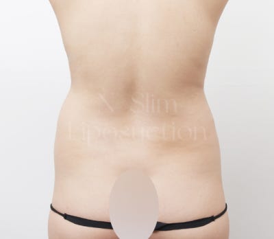 2,400cc 복부 지방흡입, 전후사진 비교 사진 7