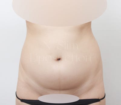 2,400cc 복부 지방흡입, 전후사진 비교