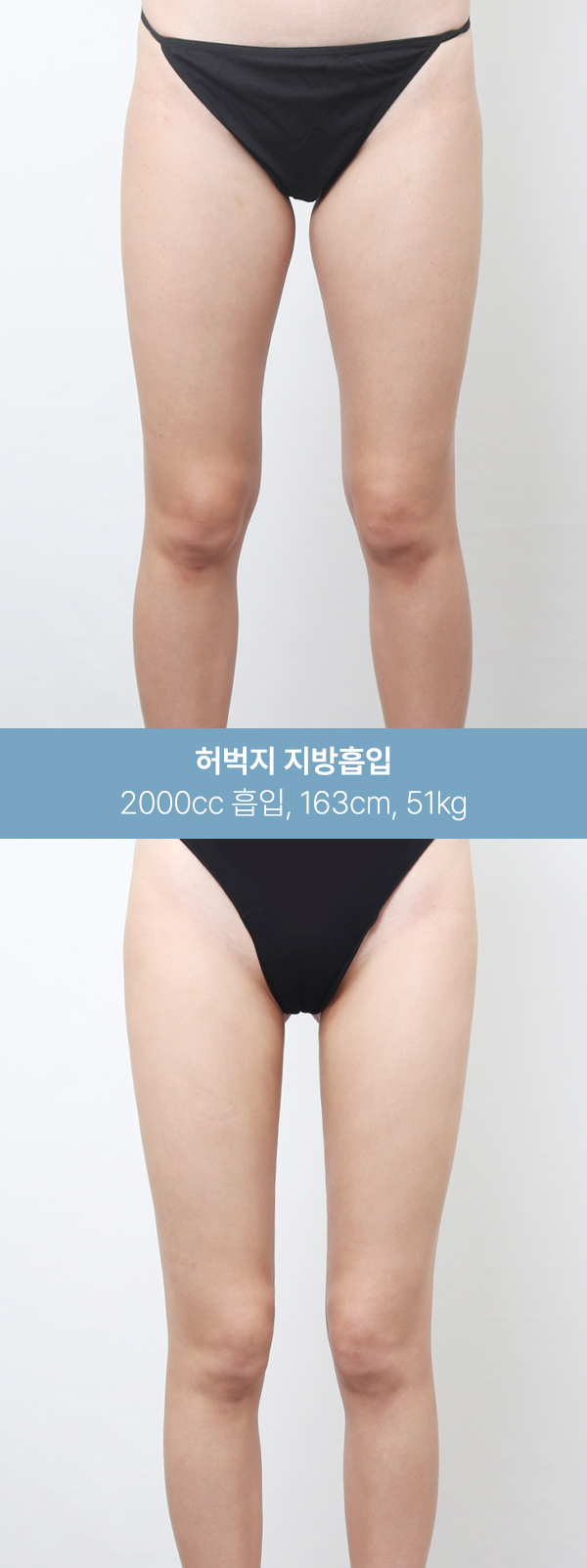 1600~2000cc 흡입 후 달라진 허벅지 라인 사진 4