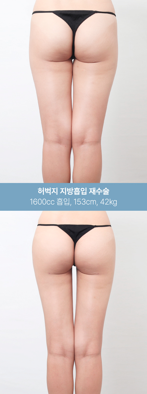 1600~2000cc 흡입 후 달라진 허벅지 라인 사진 3