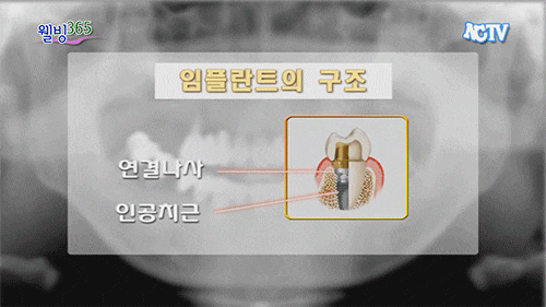 강남20대임플란트가격, 시간 등으로 미루고 있지 않나요? 사진 6