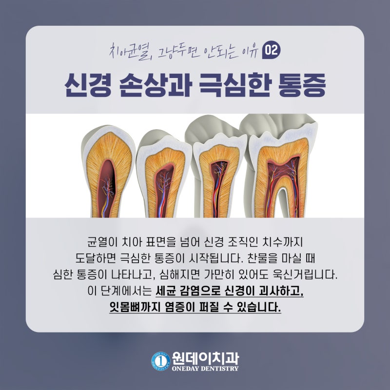 [원데이 치과]치아 균열, 그냥두면 안되는 이유! 사진 4