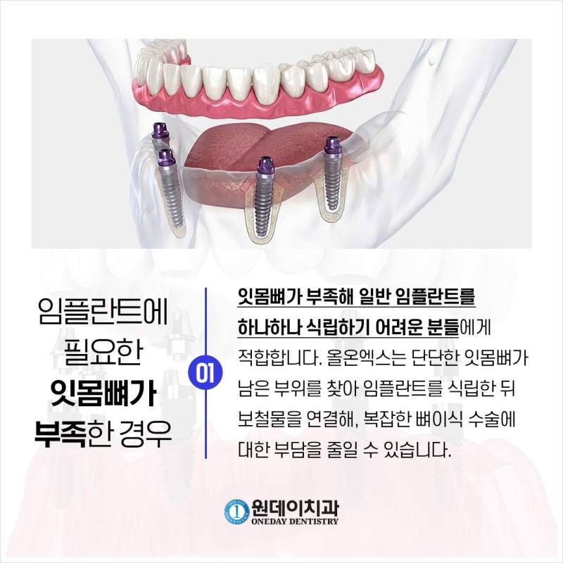 [원데이 치과]올온엑스! 누구에게 적합할까? 사진 3