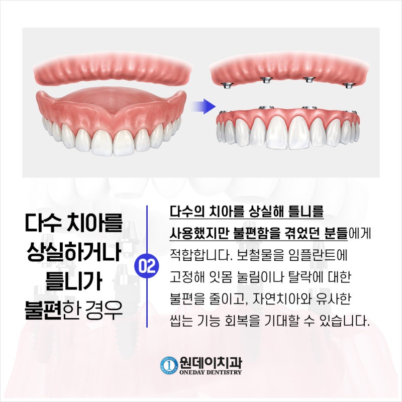[원데이 치과]올온엑스! 누구에게 적합할까? 사진 4