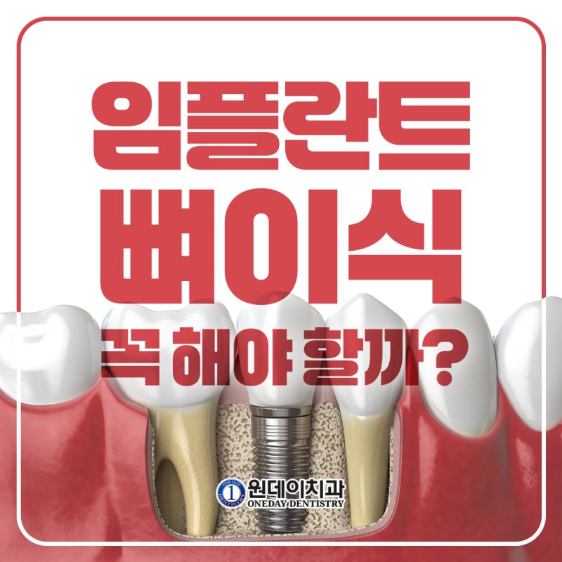 [원데이 치과]임플란트 뼈이식, 꼭 해야할까?
