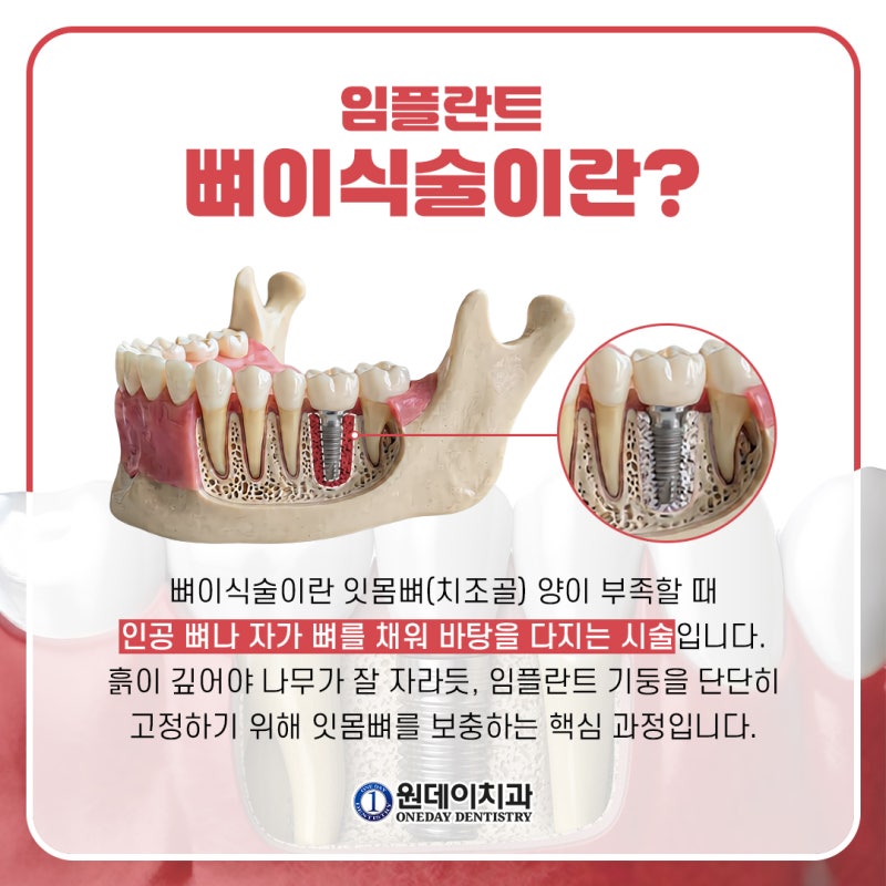 [원데이 치과]임플란트 뼈이식, 꼭 해야할까?