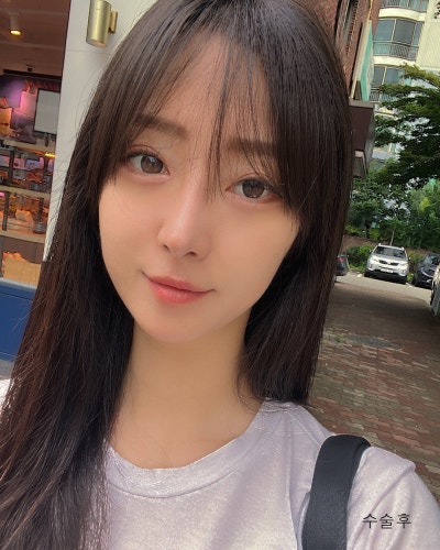 휜코 처진코끝 자려한코성형 전후 사진 11