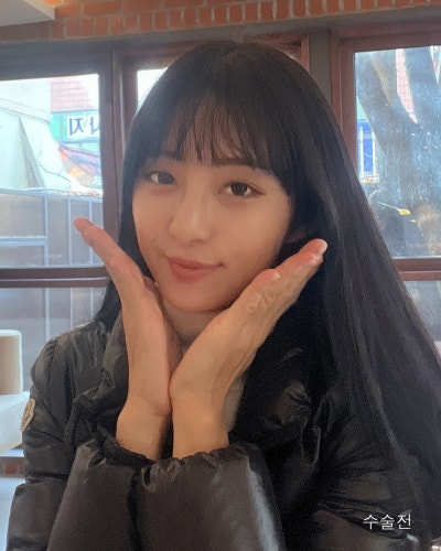 휜코 처진코끝 자려한코성형 전후 사진 10