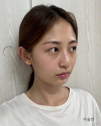 코성형 하나로 달라진 이미지 매부리코 직반코성형 전후 사진 4