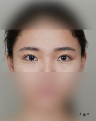 겹주름 졸린눈을 또렷하게 비절개눈매교정 전후 사진 3