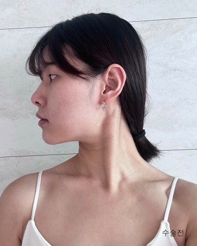 풀린눈재수술, 이마거상, 코성형 전후 사진 10