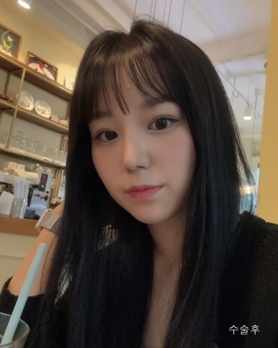 부분절개 눈매교정, 낮은코성형 전후 사진 7