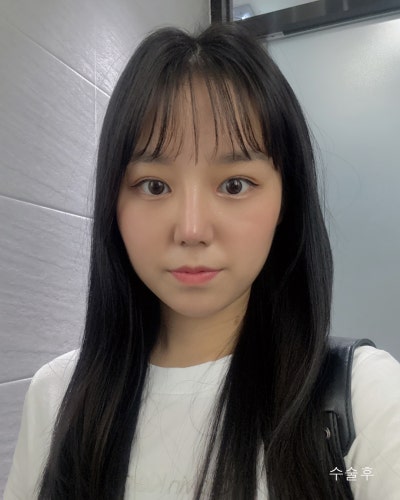 부분절개 눈매교정, 낮은코성형 전후 사진 3