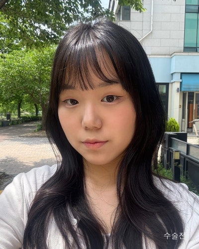 부분절개 눈매교정, 낮은코성형 전후 사진 10