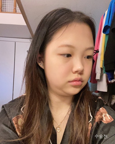 눈코성형,이마거상축소,얼굴지방흡입,실리프팅 전후 사진 4
