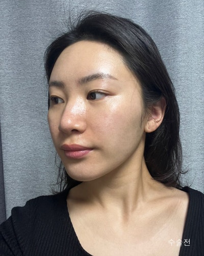 원진성형외과의원 자려한 코재수술 전후 사진 4