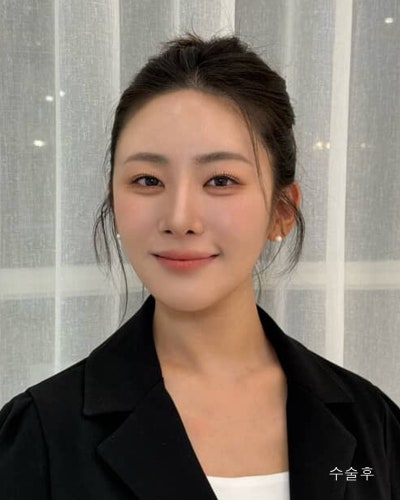 원진성형외과의원 자려한 코재수술 전후 사진 3