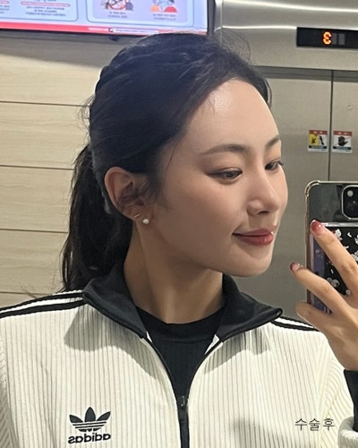 원진성형외과의원 자려한 코재수술 전후 사진 9