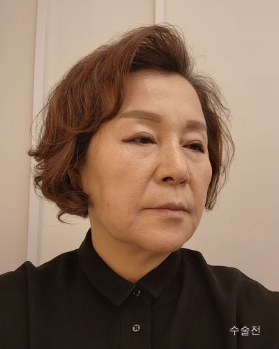 중년성형 이마축소거상, 안면거상전후와 흉터관리방법 사진 6