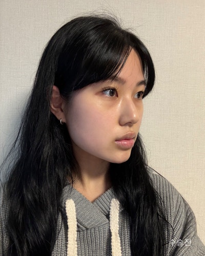 윤곽3종, 코성형 전후로 확인하는 효과 사진 2