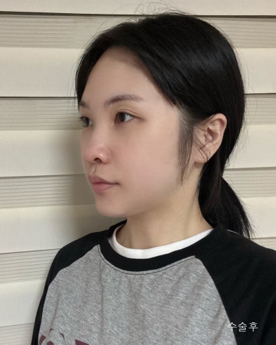 기능,미용개선 주걱턱 양악윤곽전후와 회복기간 사진 3