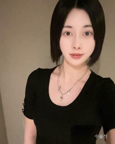 벌어진 새가슴체형 가슴골 만들기 가슴성형 전후 사진 8