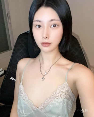 벌어진 새가슴체형 가슴골 만들기 가슴성형 전후 사진 2