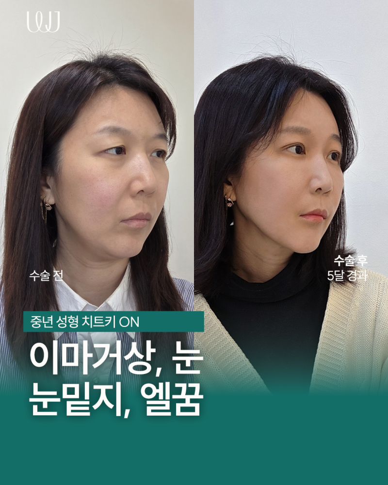 이마거상, 눈매교정, 눈밑지방재배치, 엘꿈리프팅 전후와 회복과정