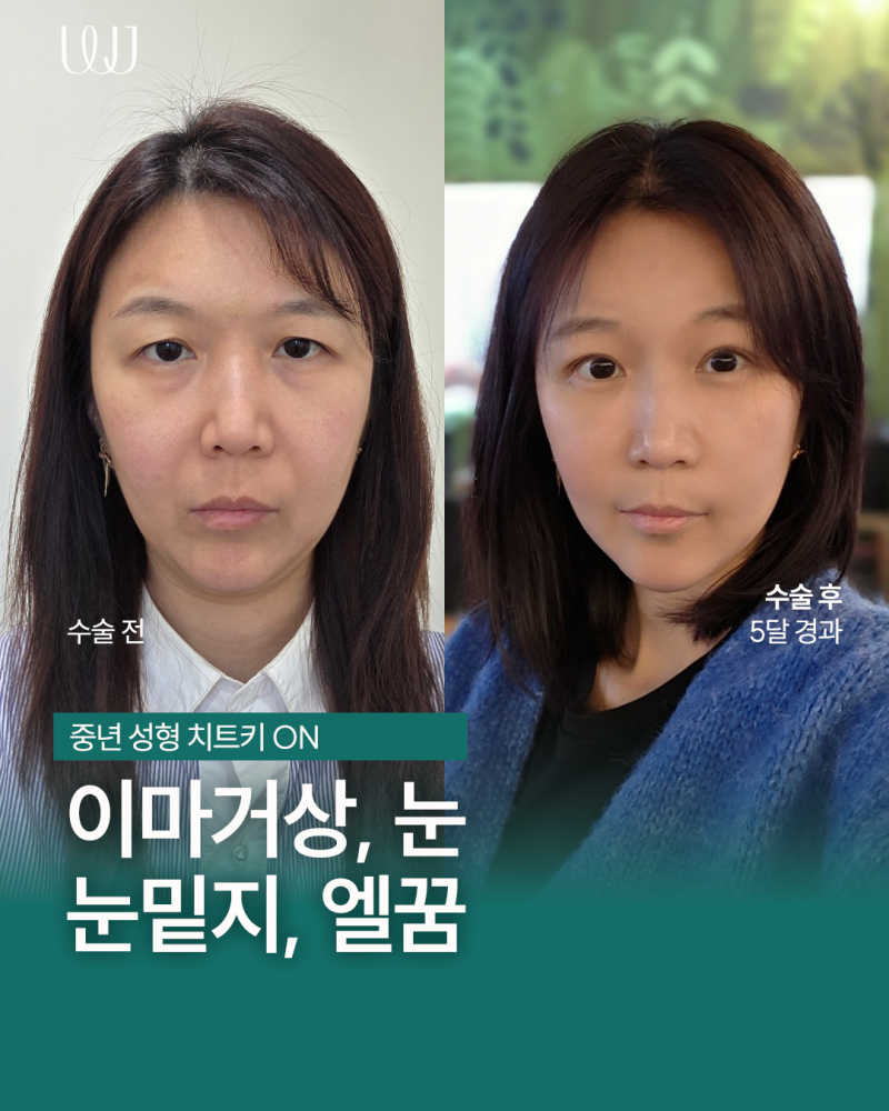 이마거상, 눈매교정, 눈밑지방재배치, 엘꿈리프팅 전후와 회복과정