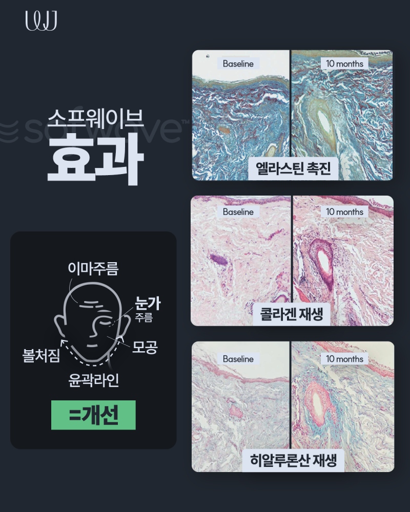 볼꺼짐 걱정 없는 소프웨이브 초음파 리프팅 사진 5