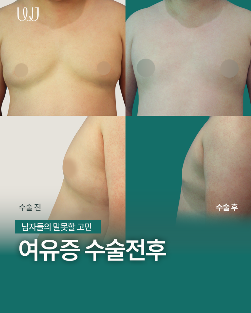 운동으로 해결 되지 않는 여유증 원인과 수술방법 사진 2