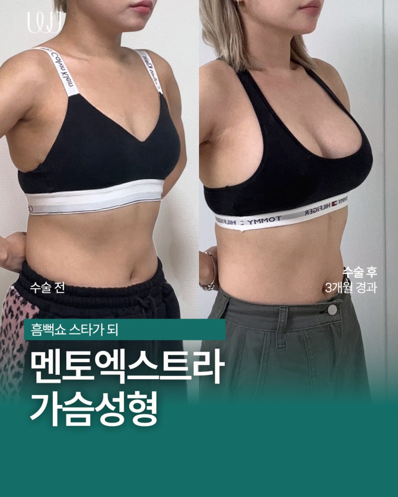 멘토엑스트라 가슴성형 전후와 회복과정