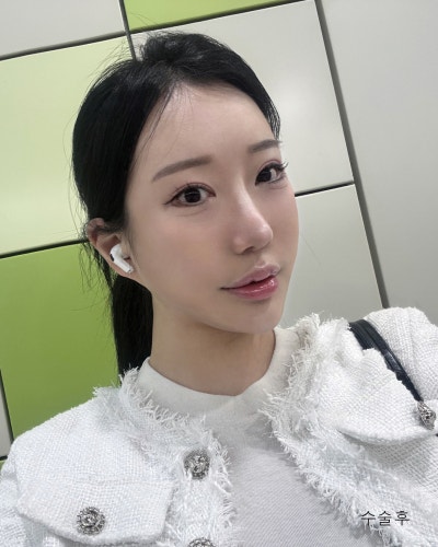 돌출된 광대 윤곽3종 전후와 회복기간 사진 7